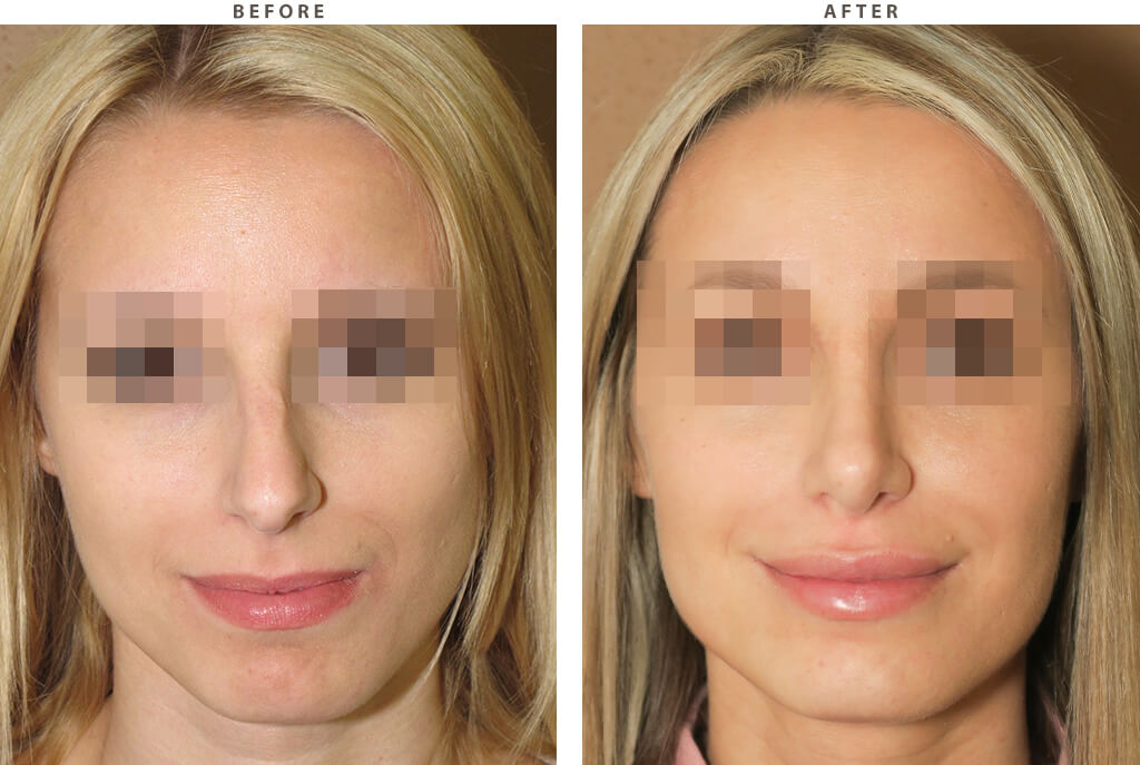Rhinoplasty - Before and After Pictures
