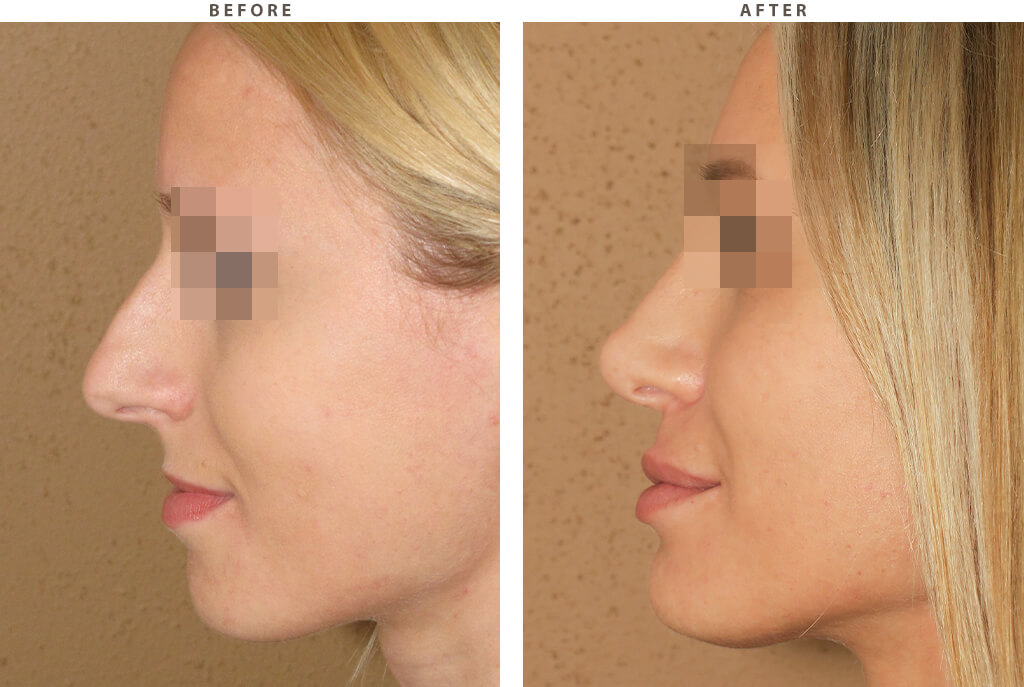 Rhinoplasty - Before and After Pictures