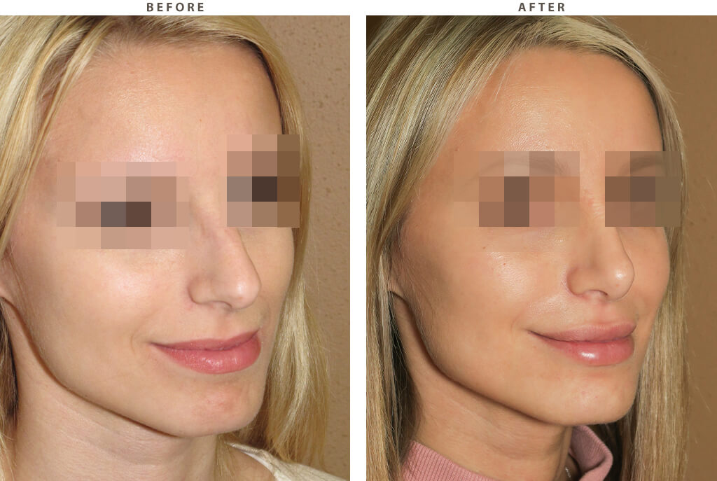 Rhinoplasty - Before and After Pictures