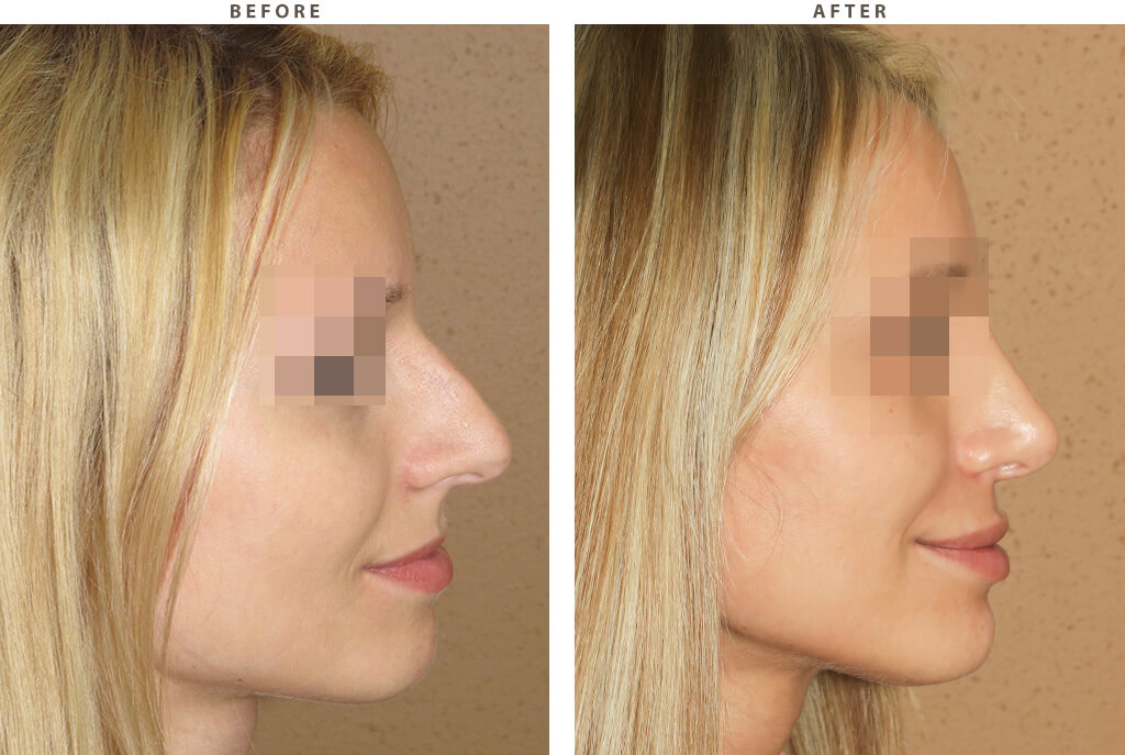 Rhinoplasty - Before and After Pictures