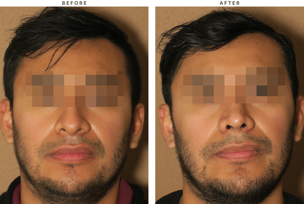 Rhinoplasty - Before and After Pictures