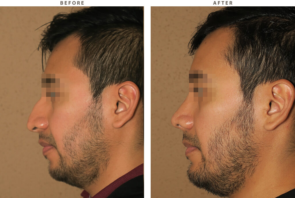 Rhinoplasty - Before and After Pictures