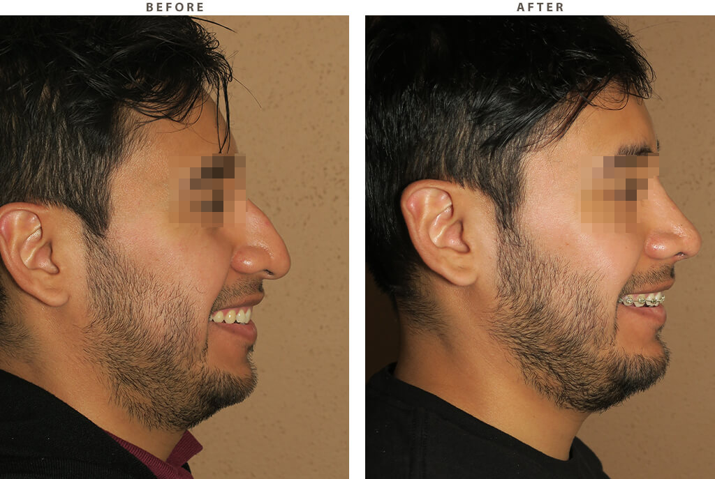 Rhinoplasty - Before and After Pictures