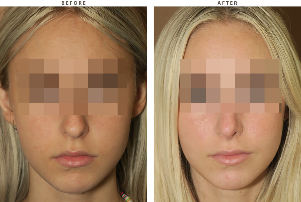 Abdominoplasty Chicago - Before and After Pictures