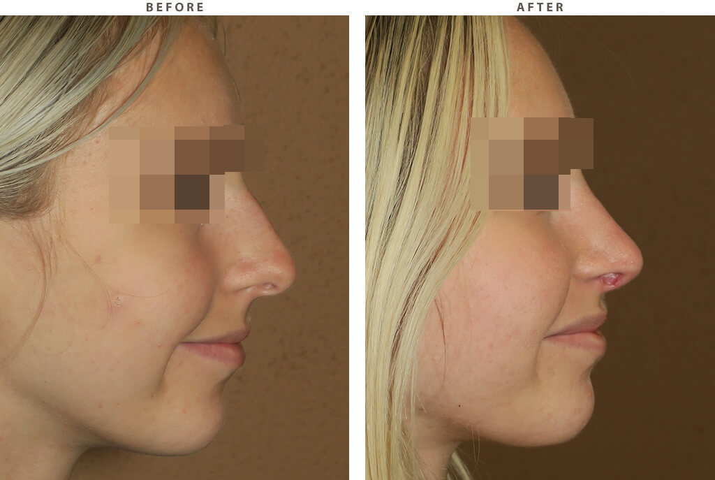 Rhinoplasty Chicago - Before and After Pictures