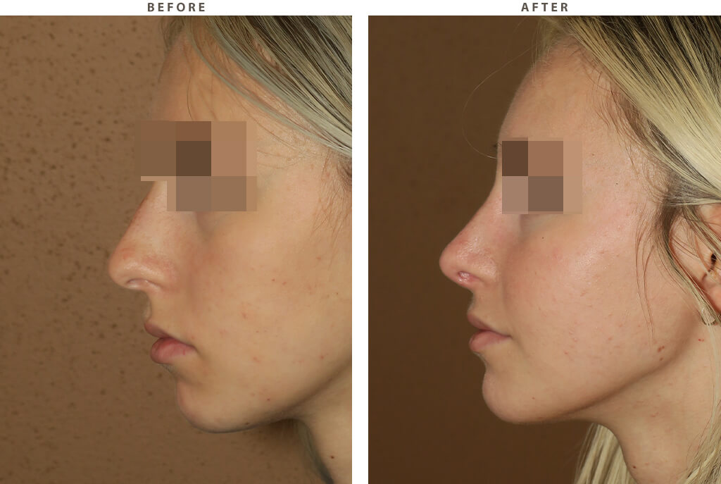 Rhinoplasty Chicago - Before and After Pictures