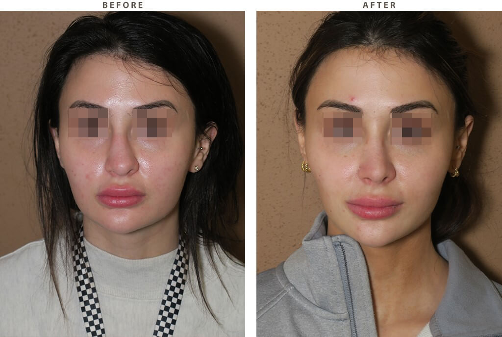 Revision rhinoplasty Chicago - Before and After Pictures