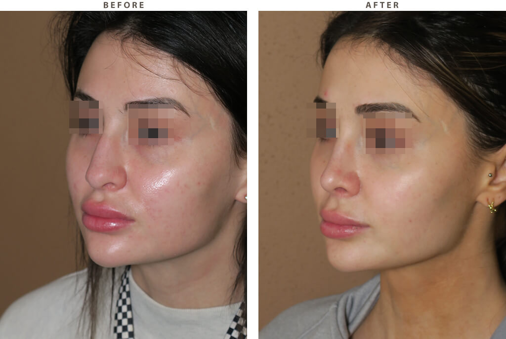 Revision rhinoplasty Chicago - Before and After Pictures