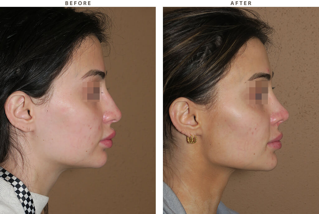 Revision rhinoplasty Chicago - Before and After Pictures