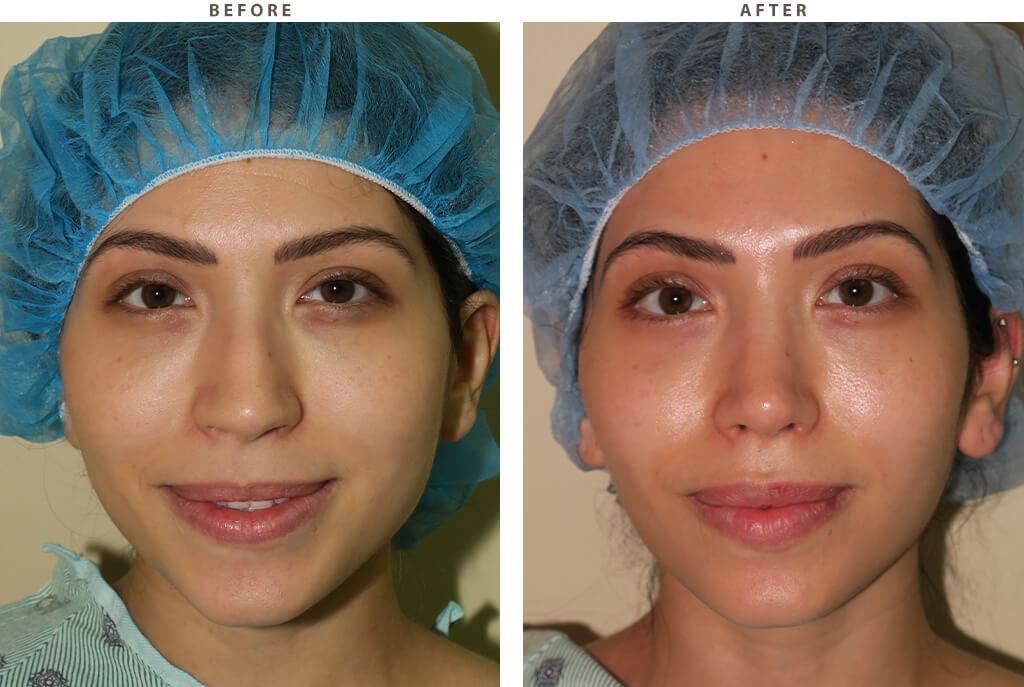 Rhinoplasty - Before and After Pictures