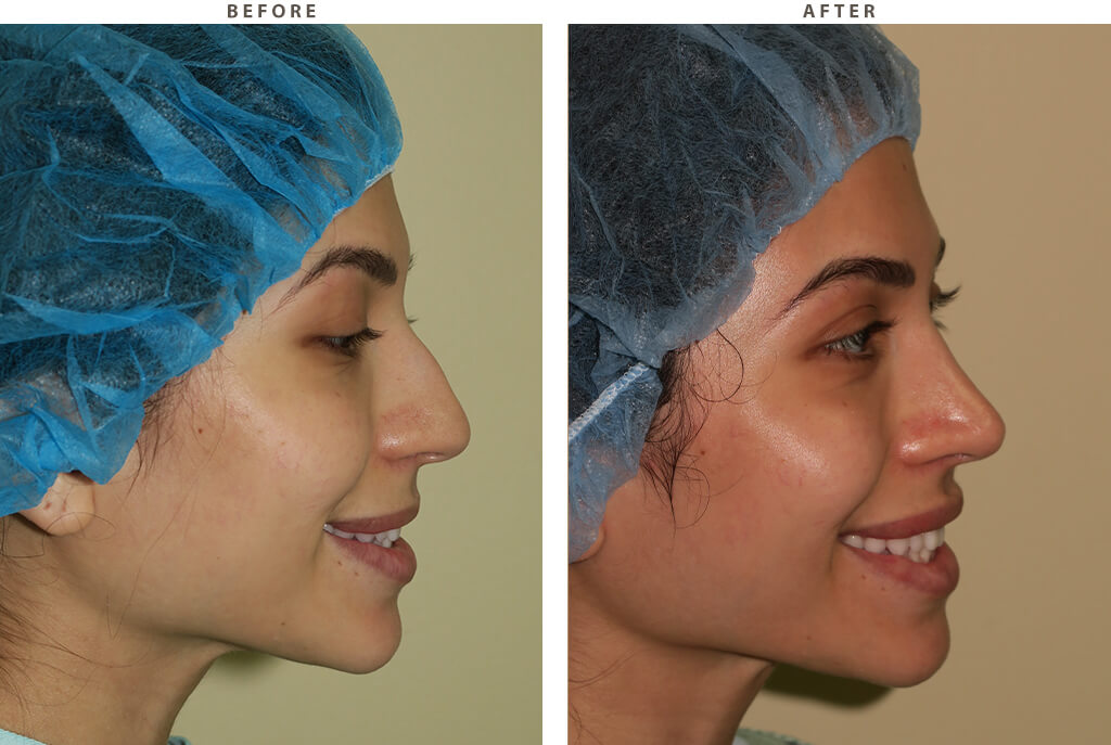 Rhinoplasty - Before and After Pictures