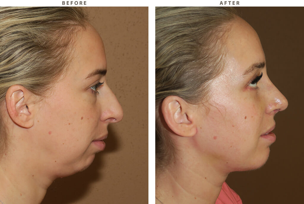 Chin augmentation - Before and After Pictures