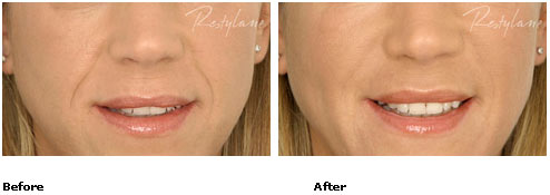 Restylane - Nasolabial Folds - Before & After Pictures Restylane - Nasolabial Folds - Before & After Pictures
