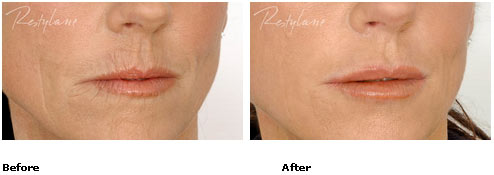 Restylane - Lips - Before & After Pictures Restylane - Lips - Before & After Pictures