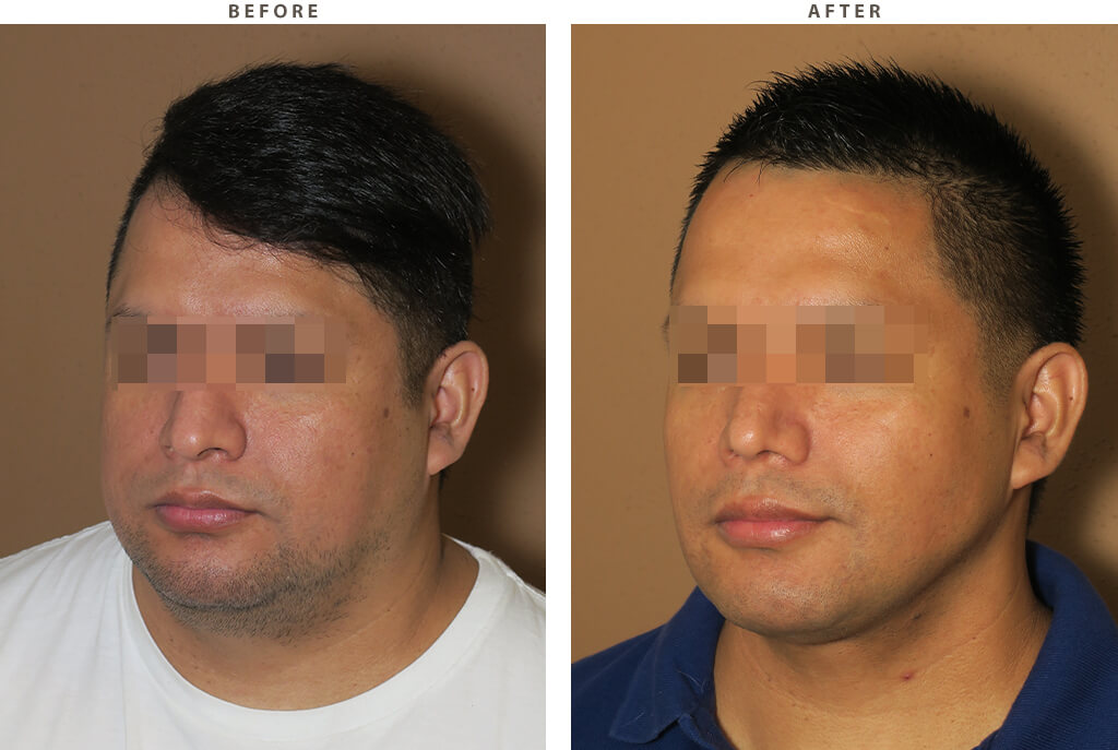 Face combo - Before and After Pictures