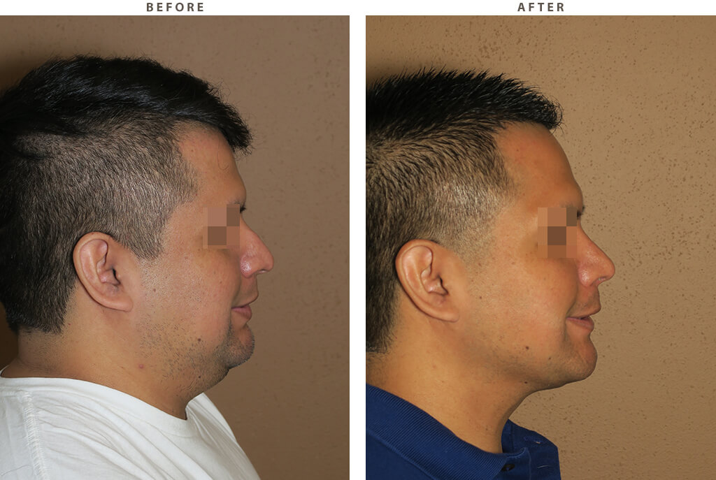 Face combo - Before and After Pictures