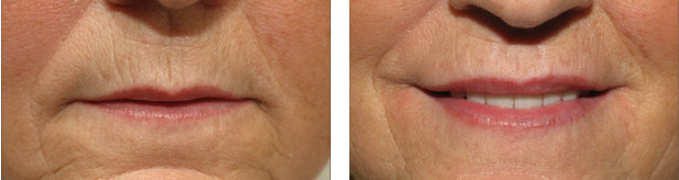Juvederm Juvederm