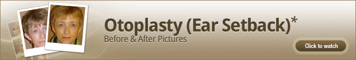 Otoplasty (Ear Setback) – Before & After Pictures Otoplasty (Ear Setback) – Before & After Pictures