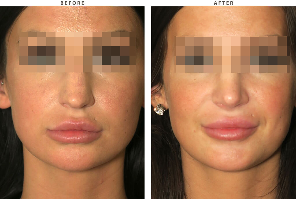 Rhinoplasty - Before and After Pictures