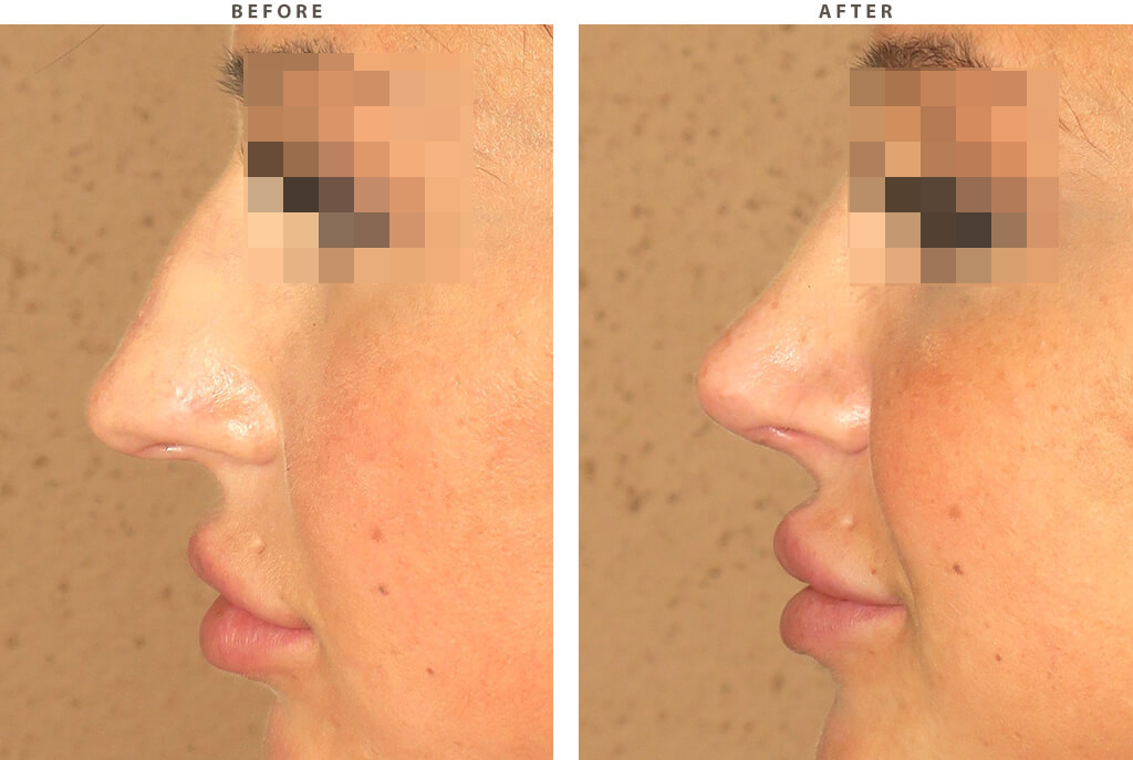 Rhinoplasty - Before and After Pictures