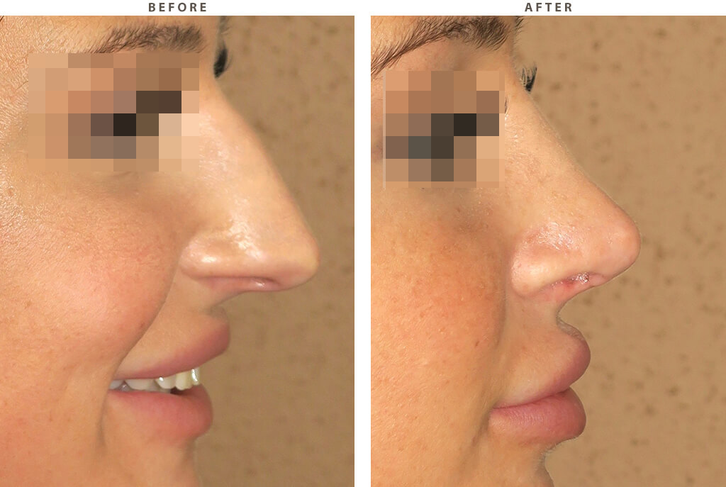 Rhinoplasty - Before and After Pictures