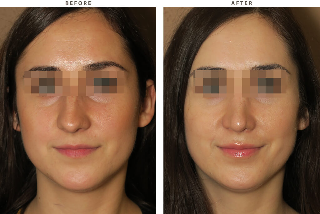 Rhinoplasty - Before and After Pictures