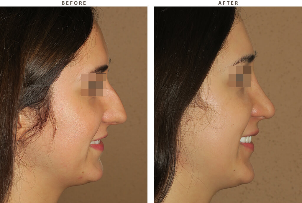 Rhinoplasty - Before and After Pictures