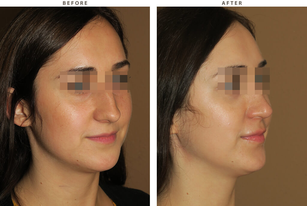 Rhinoplasty - Before and After Pictures