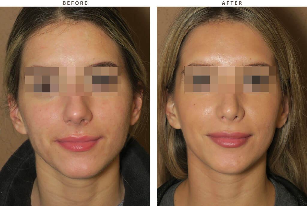 Rhinoplasty - Before and After Pictures