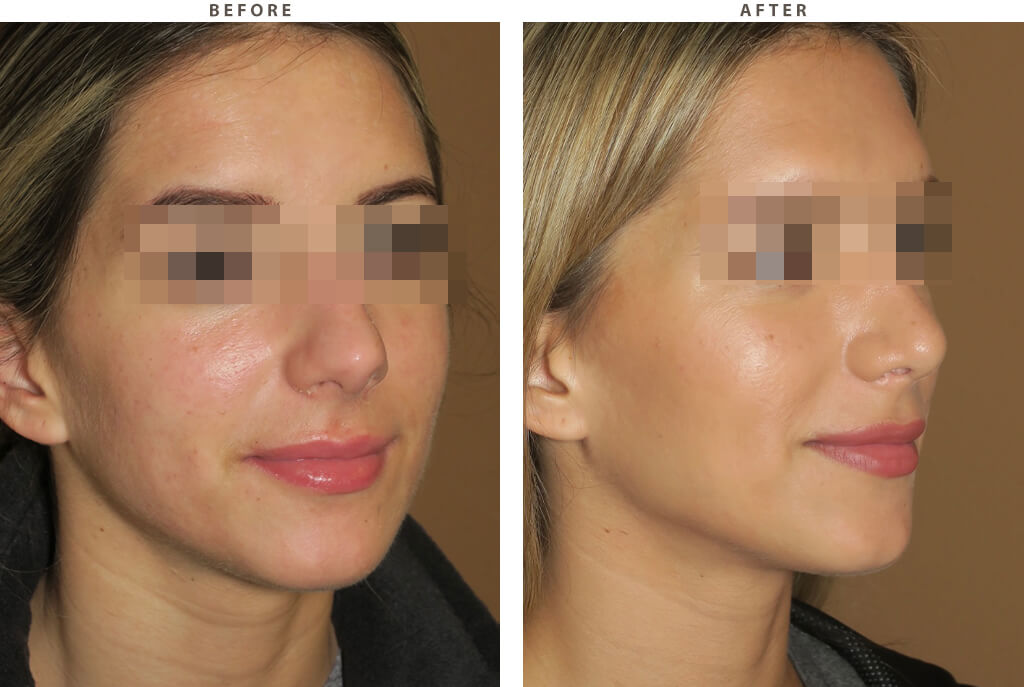 Rhinoplasty - Before and After Pictures