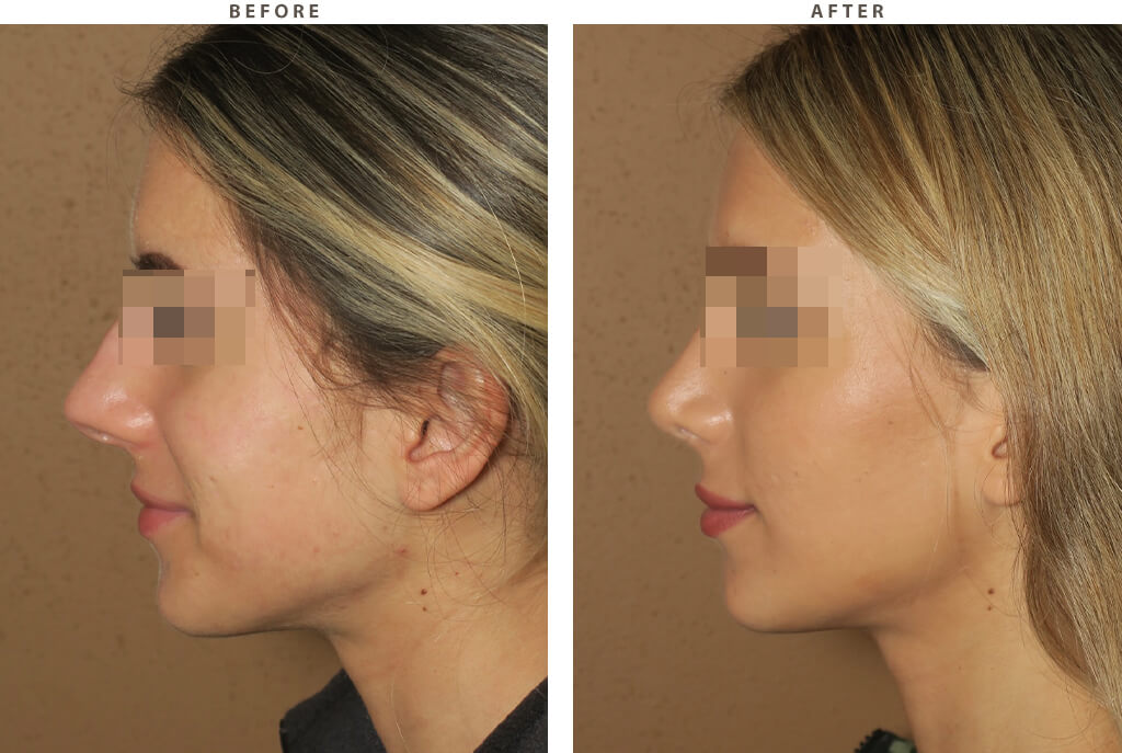 Rhinoplasty - Before and After Pictures