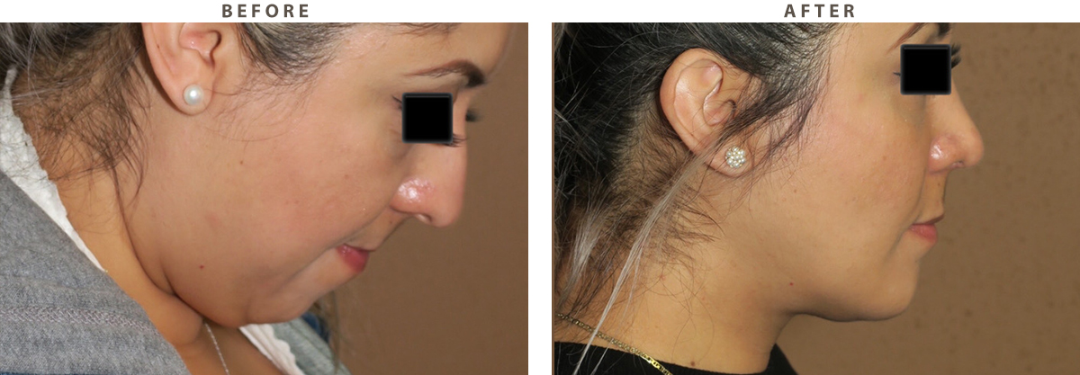 Rhinoplasty - Before and After Pictures