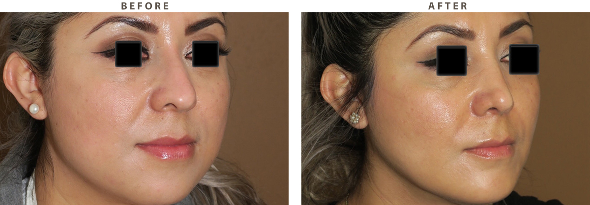 Rhinoplasty - Before and After Pictures