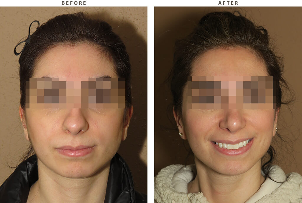 Rhinoplasty - Before and After Pictures