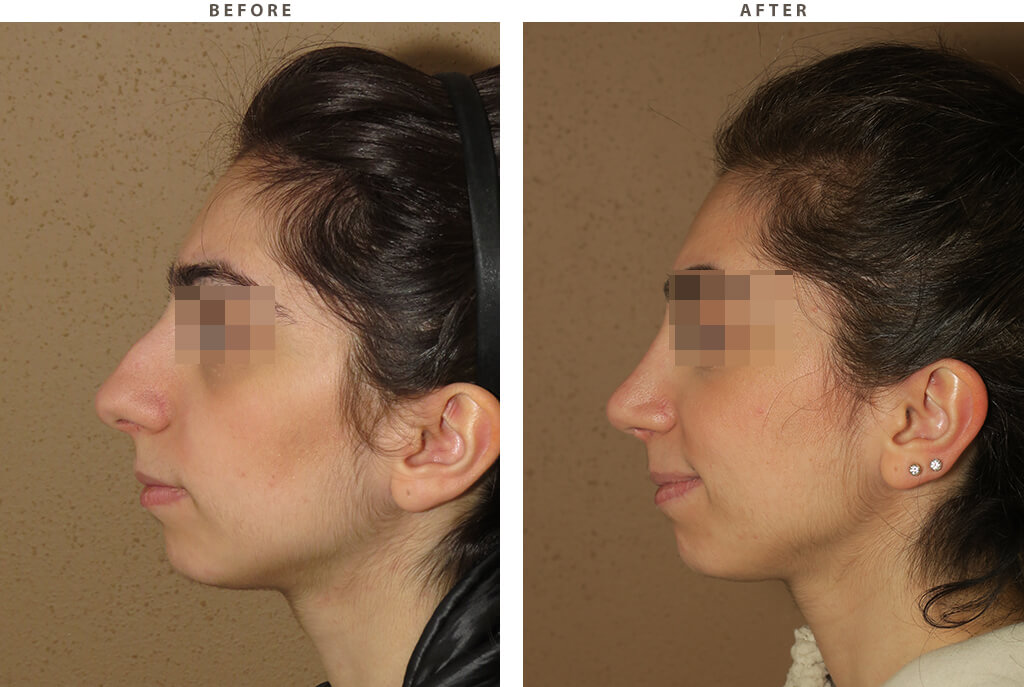 Rhinoplasty - Before and After Pictures