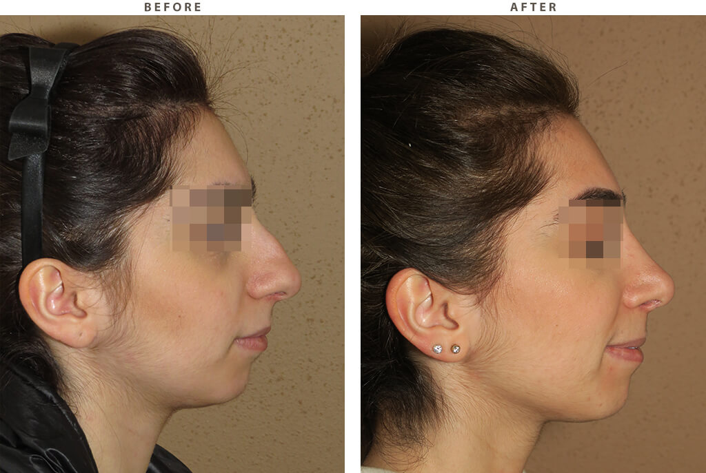 Rhinoplasty - Before and After Pictures