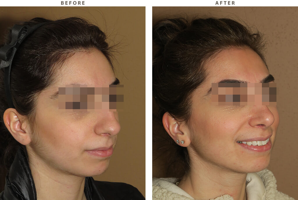 Rhinoplasty - Before and After Pictures