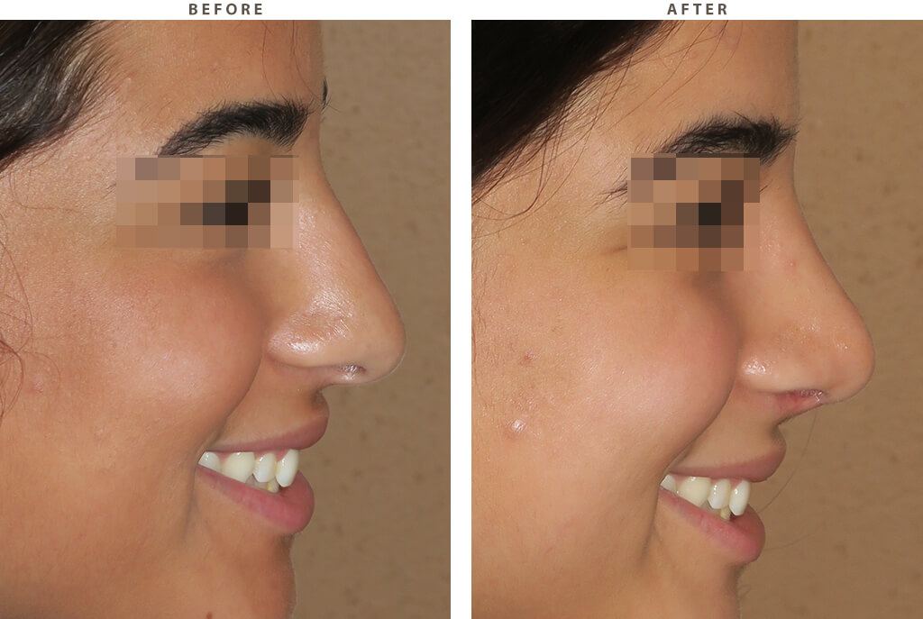 Rhinoplasty - Before and After Pictures