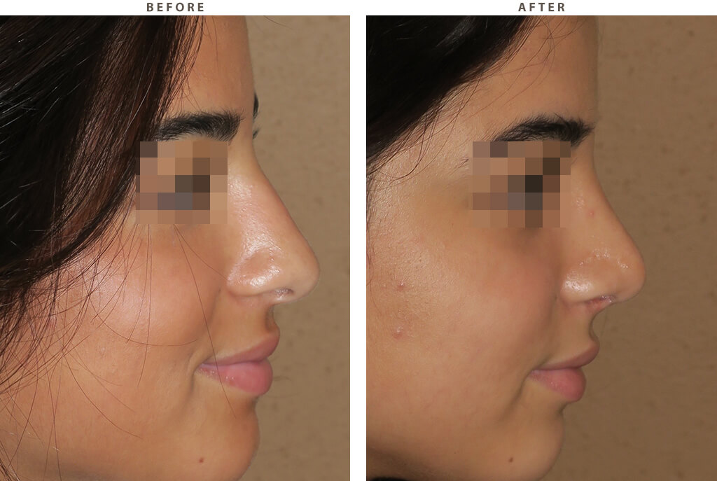 Rhinoplasty - Before and After Pictures