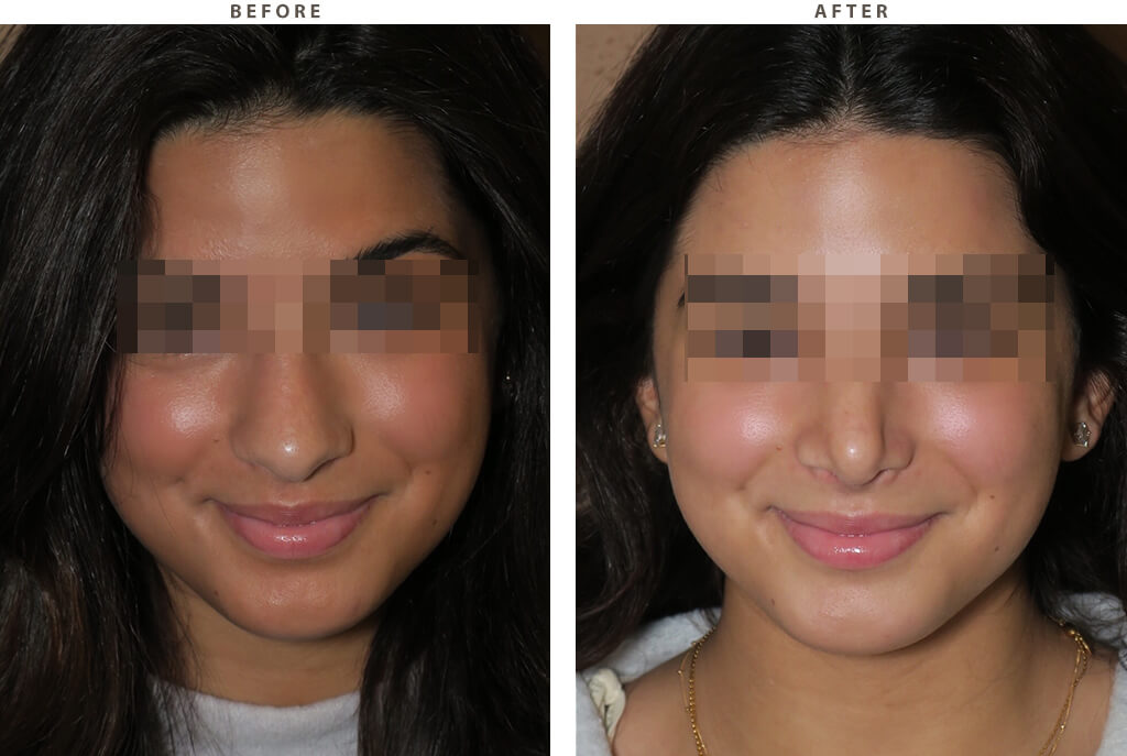 Rhinoplasty - Before and After Pictures