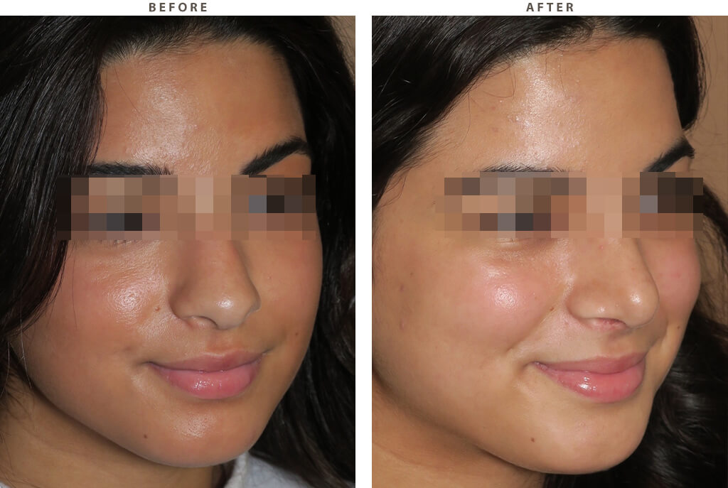Rhinoplasty - Before and After Pictures