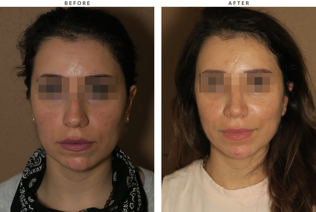 Rhinoplasty - Before and After Pictures