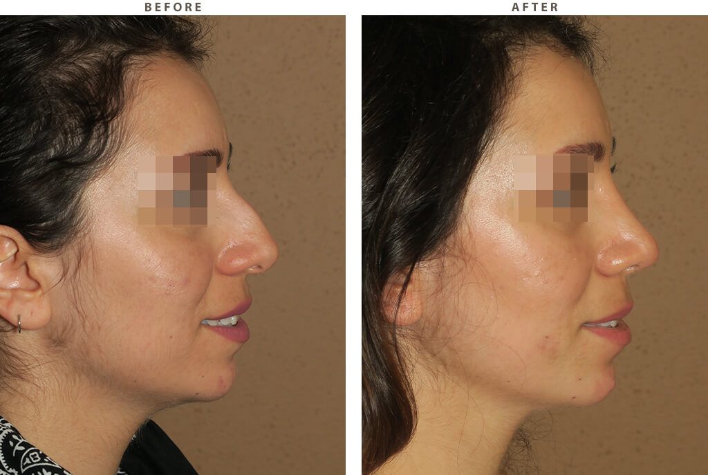 Rhinoplasty - Before and After Pictures
