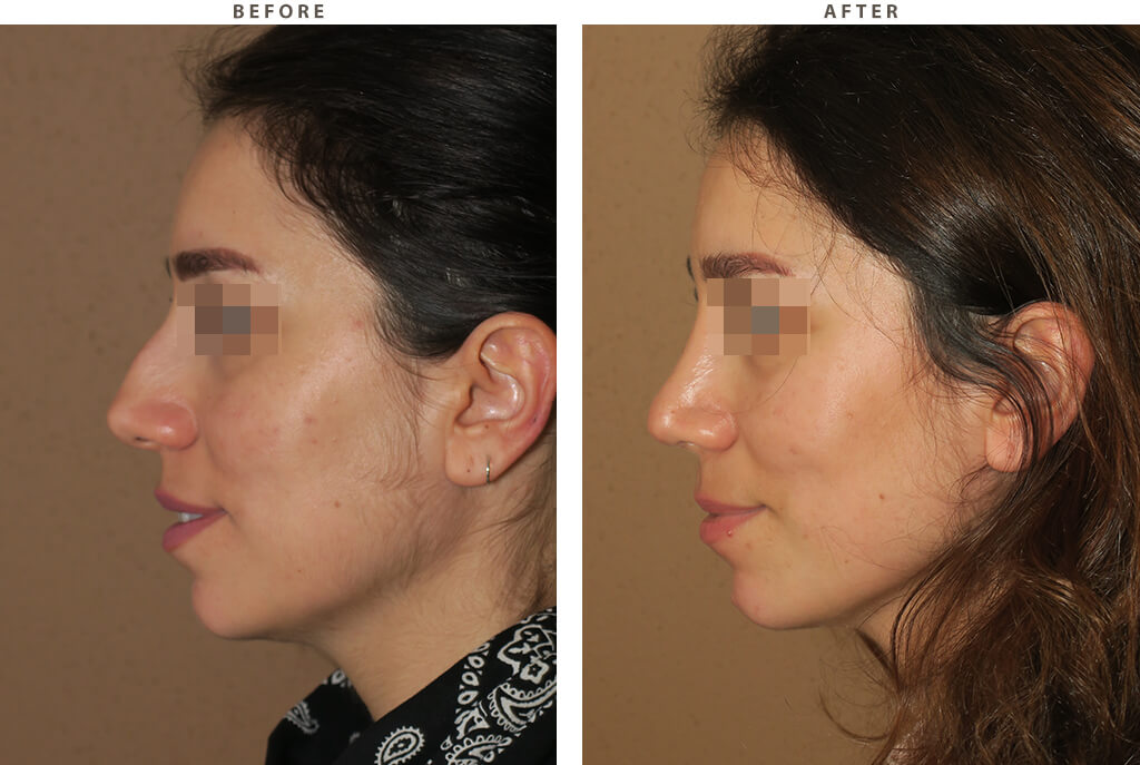 Rhinoplasty - Before and After Pictures