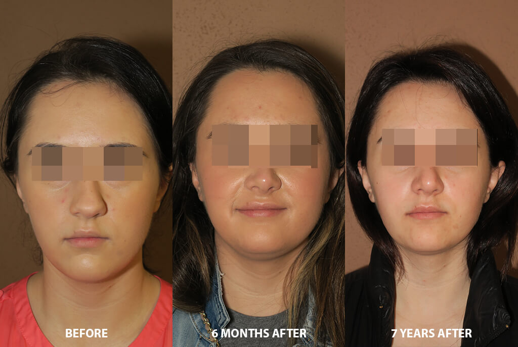 Rhinoplasty - Before and After Pictures