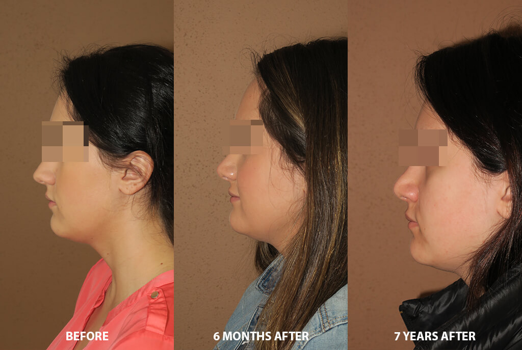 Rhinoplasty - Before and After Pictures