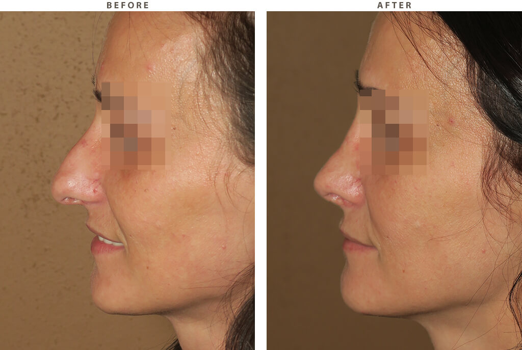 Rhinoplasty - Before and After Pictures