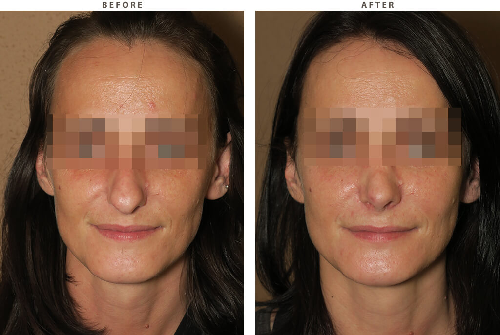 Rhinoplasty - Before and After Pictures