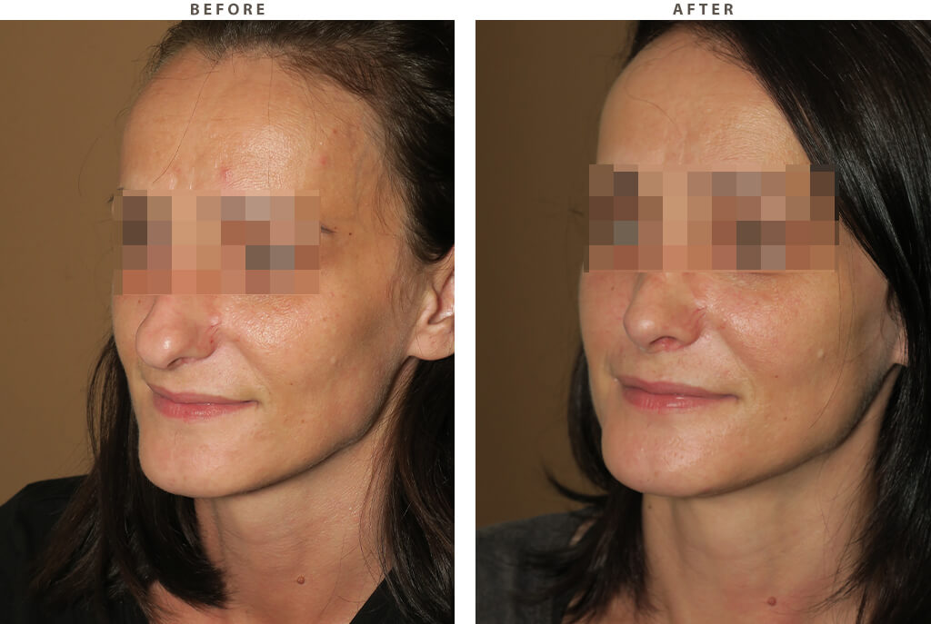 Rhinoplasty - Before and After Pictures