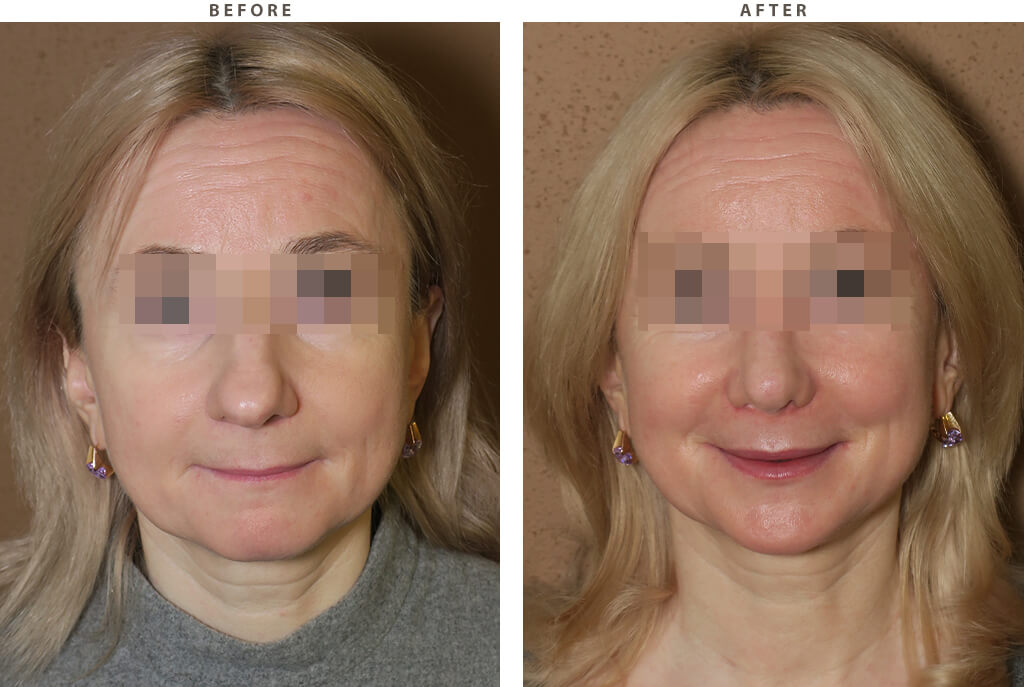 Rhinoplasty - Before and After Pictures